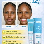 Gel anti-acné à l’acide salicylique